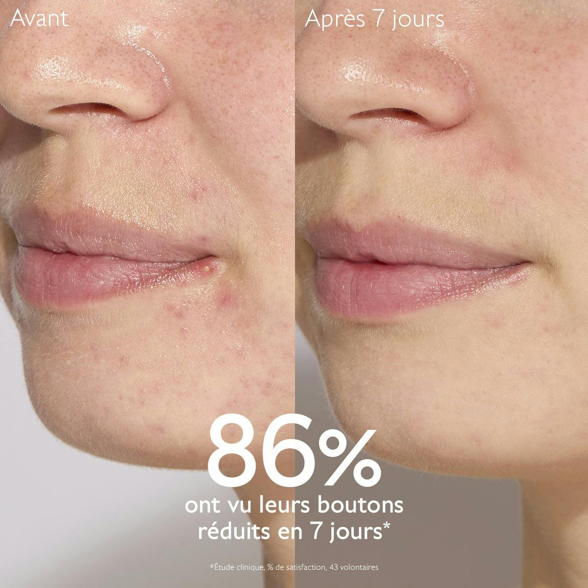 Sérum à l'Acide Salicylique Anti-imperfections